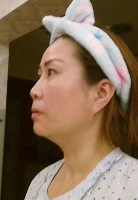 去眼袋手术
