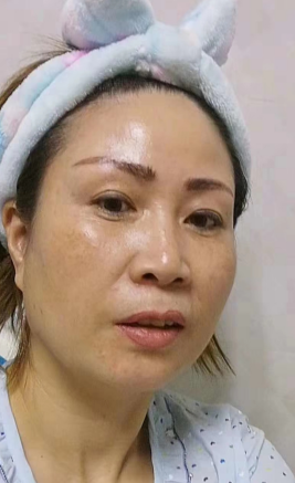 去眼袋手术