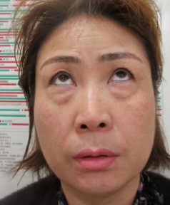 去眼袋手术