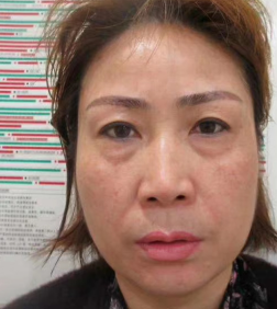 去眼袋手术