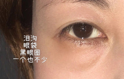 去眼袋手术