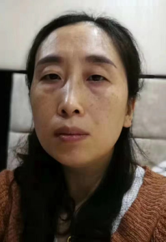 去眼袋手术