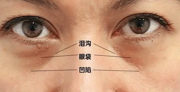 去眼袋手术