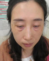 去眼袋手术