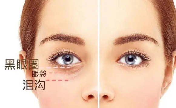 去眼袋手术