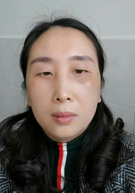 去眼袋手术