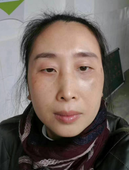 去眼袋手术