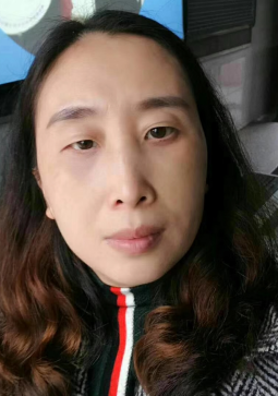 去眼袋手术