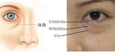 去眼袋手术