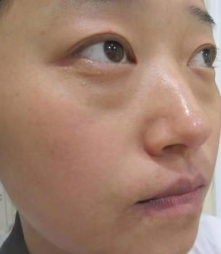 去眼袋手术