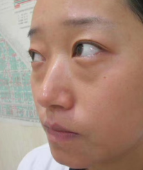 去眼袋手术