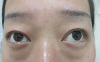 去眼袋手术