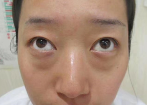 去眼袋手术
