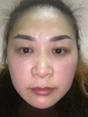 去眼袋手术