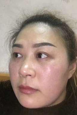 去眼袋手术