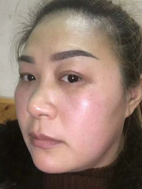 去眼袋手术