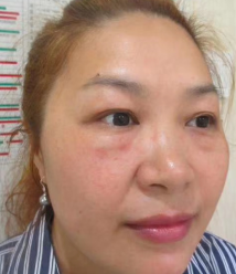 去眼袋手术