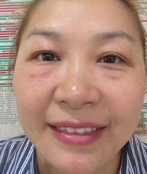 去眼袋手术