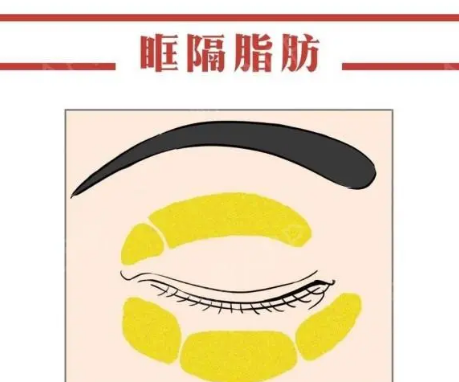 去眼袋手术