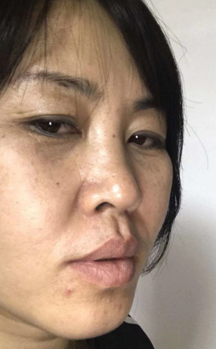 去眼袋手术