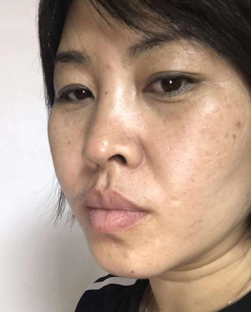 去眼袋手术