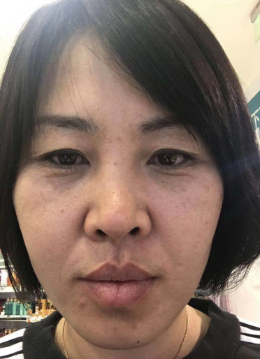 去眼袋手术