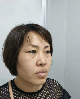 去眼袋手术