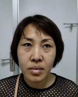去眼袋手术