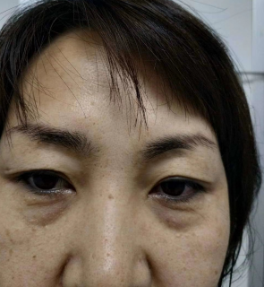 去眼袋手术