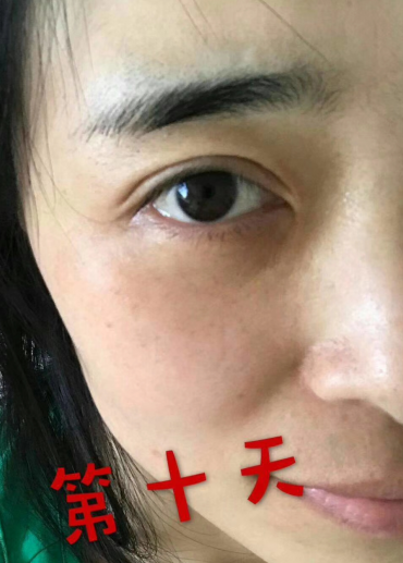 去眼袋手术