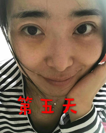 去眼袋手术