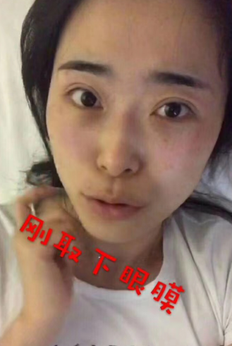 去眼袋手术