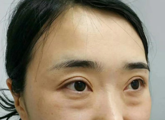 去眼袋手术