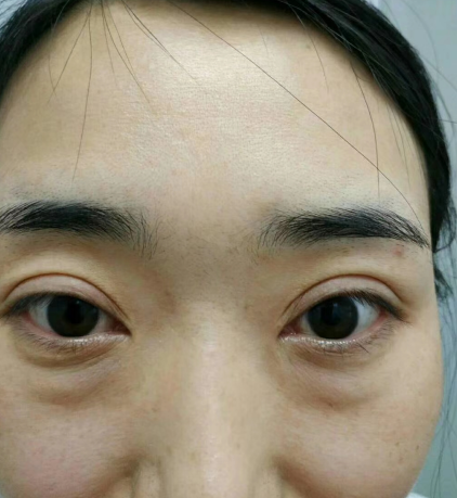 去眼袋手术