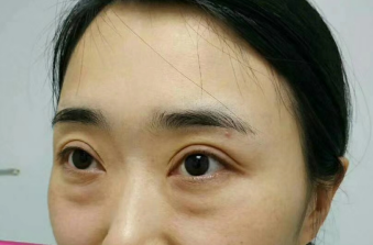 去眼袋手术