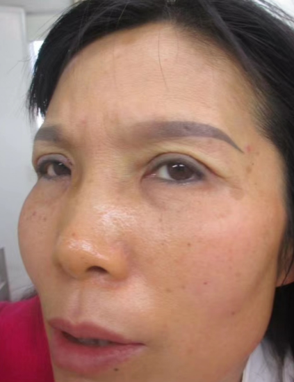 双眼皮手术