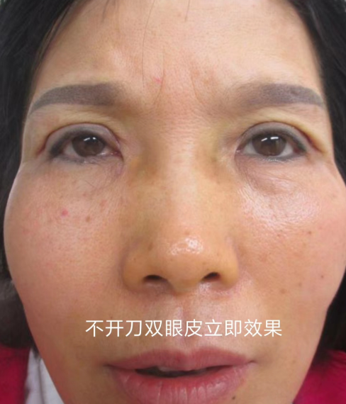 双眼皮手术