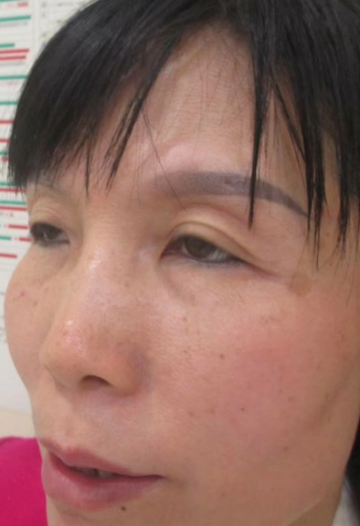 双眼皮手术