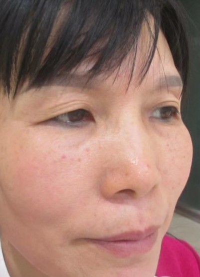 双眼皮手术