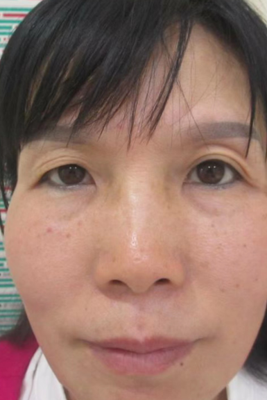 双眼皮手术