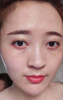 去眼袋手术
