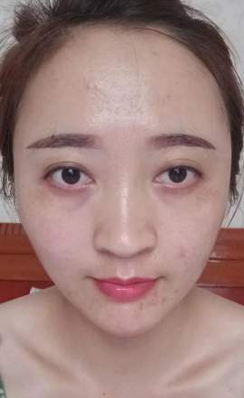 去眼袋手术