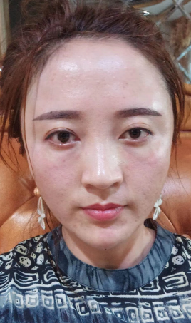 去眼袋手术