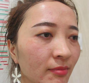 去眼袋手术