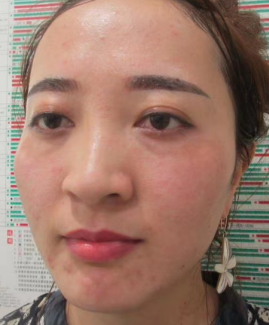 去眼袋手术