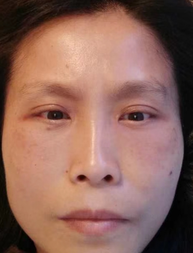 去眼袋手术
