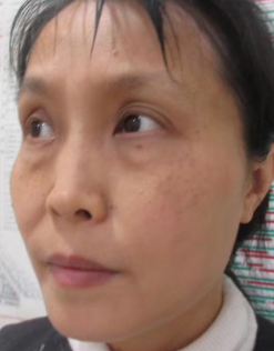 去眼袋手术