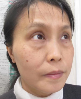 去眼袋手术