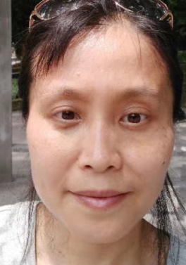 去眼袋手术