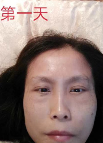 去眼袋手术